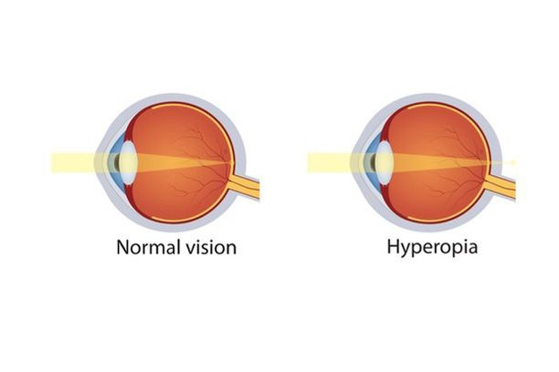 Hyperopia (Farsightedness): Causes, Symptoms, Correction, and Eye Health