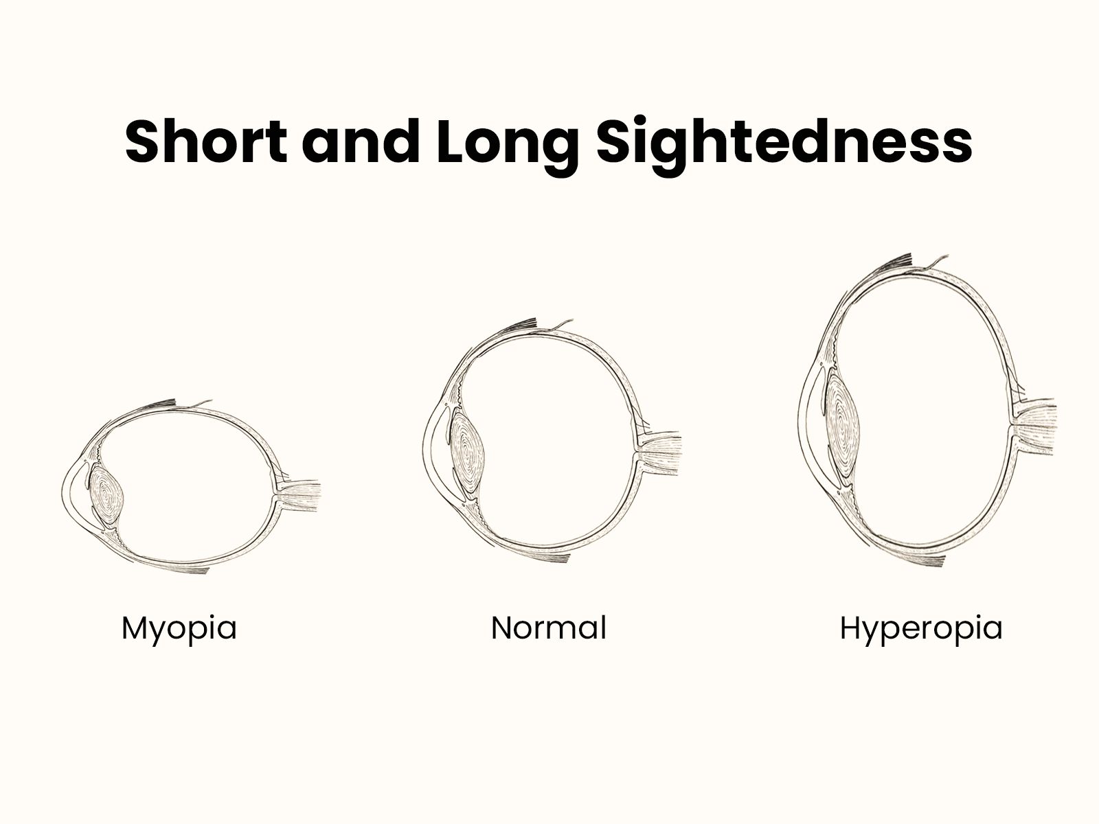 Nearsighted vs Farsighted: Key Differences, Symptoms, and Stylish Solutions