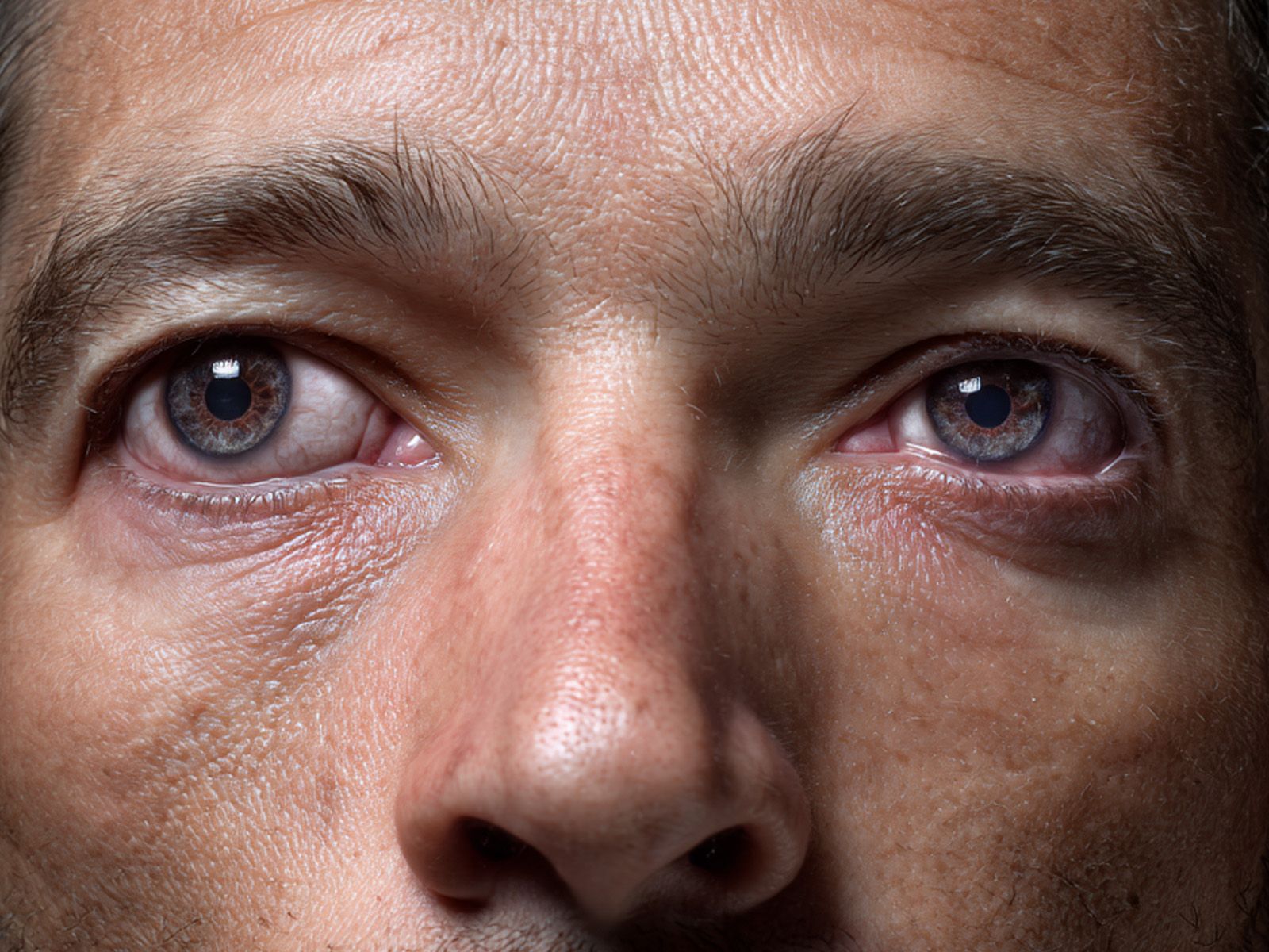 Understanding exotropia: Why do eyes "look outward"?