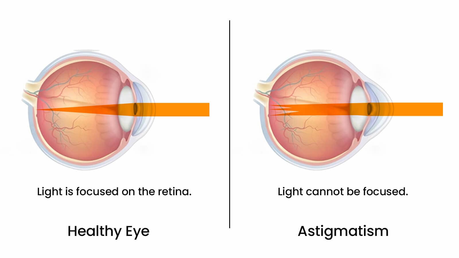 What is Astigmatism? Causes, Symptoms, and Eyes Care Tips