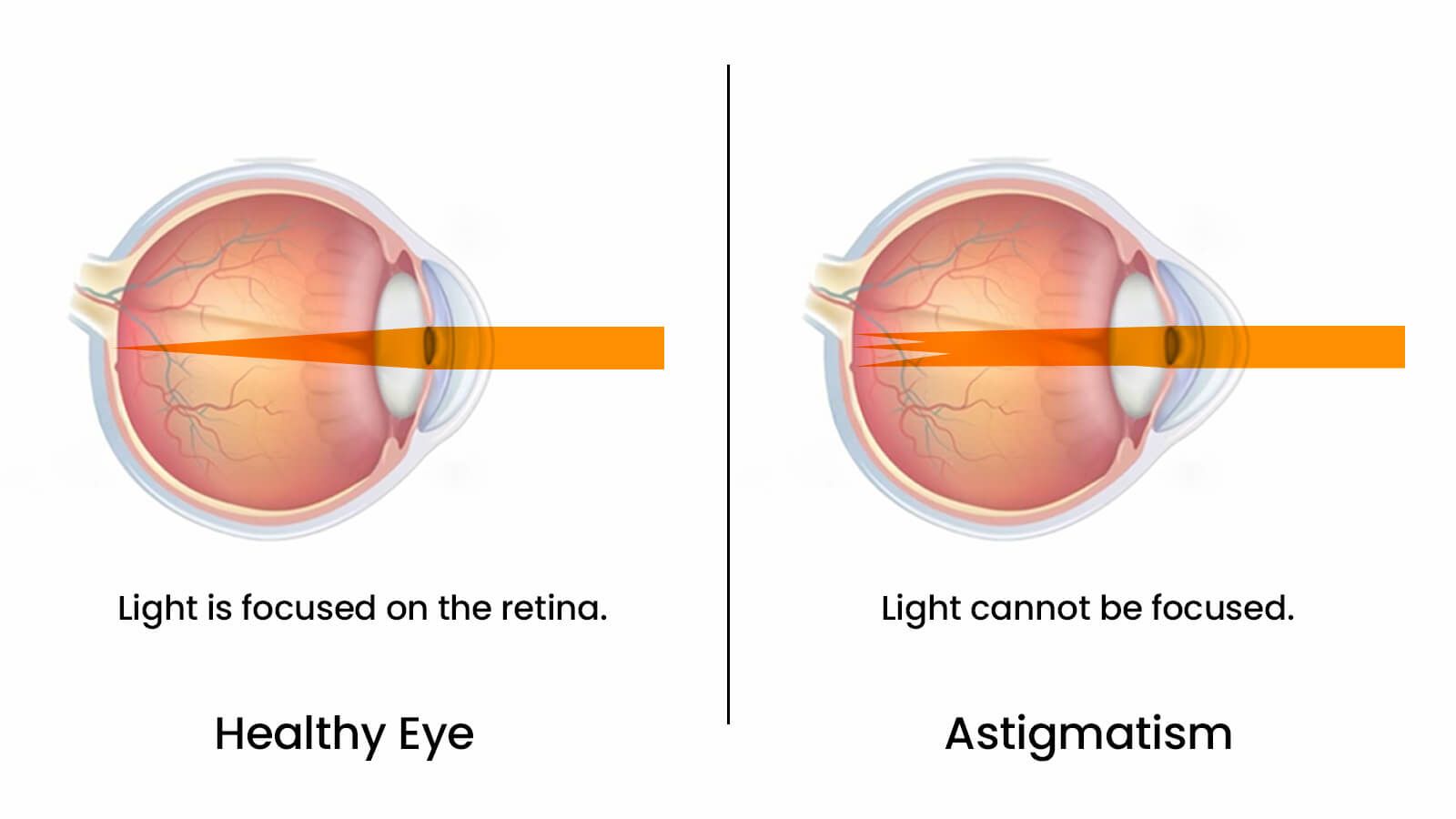 What is Astigmatism? Astigmatism Vs. Normal Vision