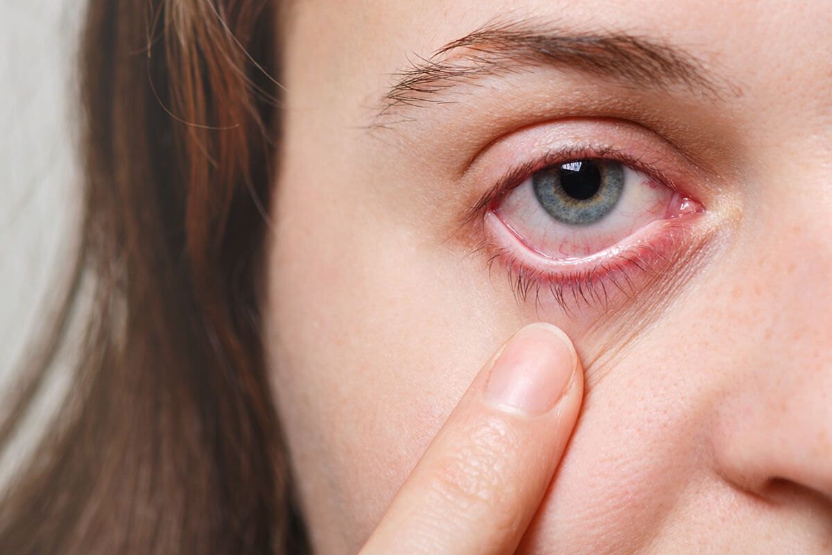 Uveitis: Symptoms, Causes, Diagnosis, Treatment & When to Seek Immediate Help