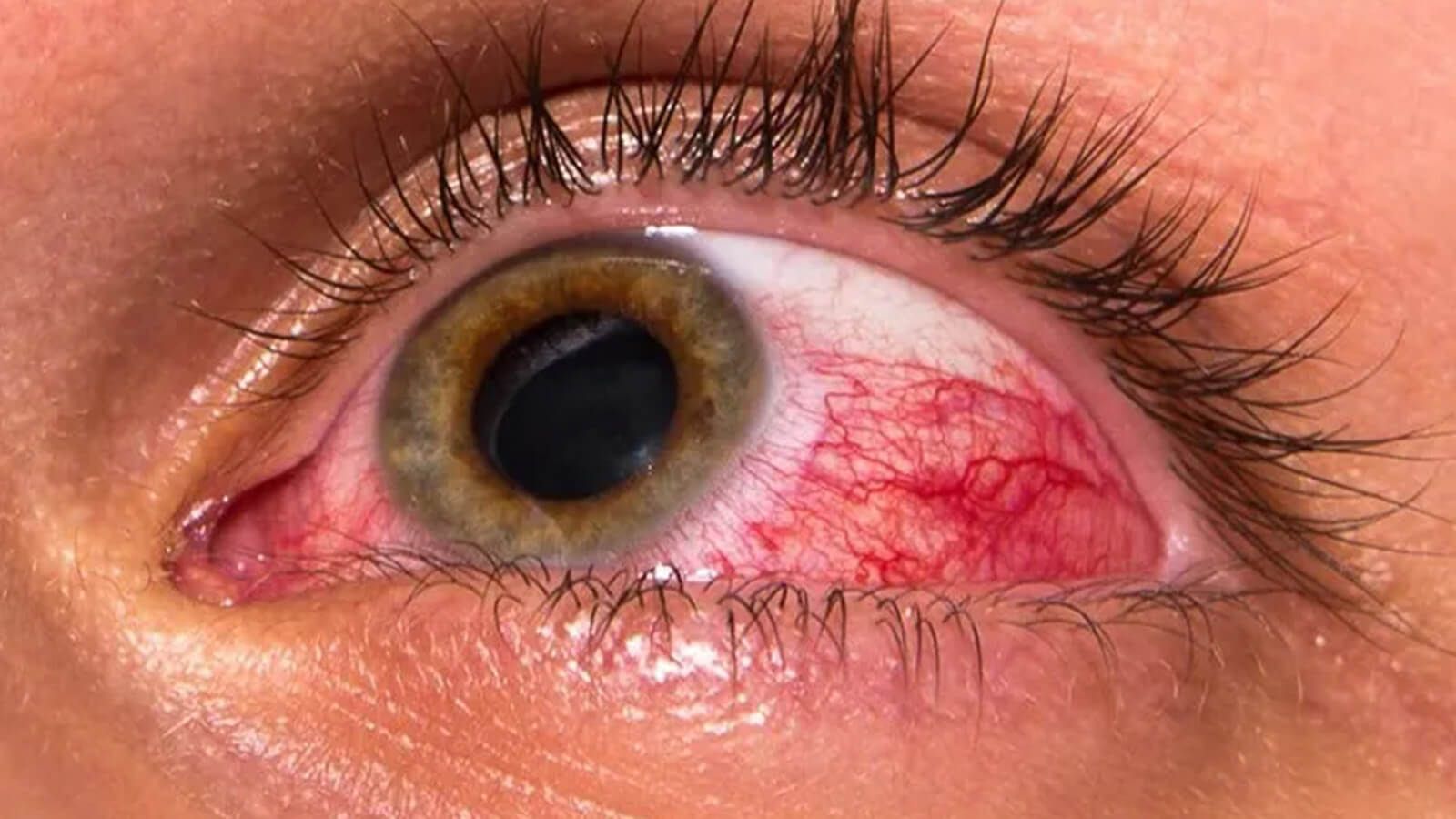 Eyes with Preseptal Cellulitis