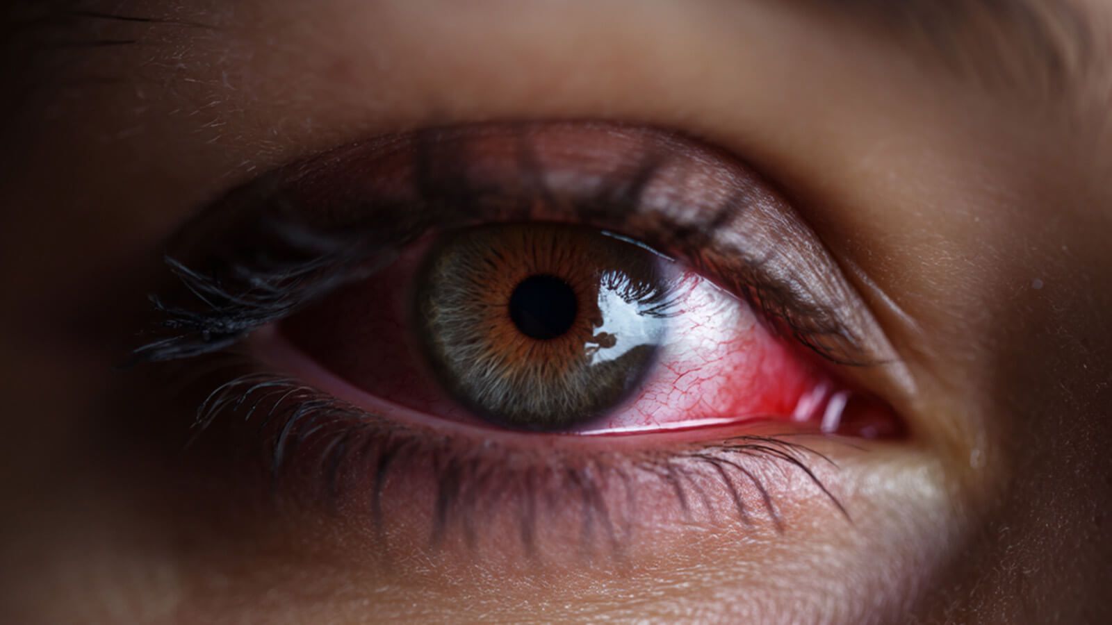 Uveal inflammation causing corneal hemorrhage