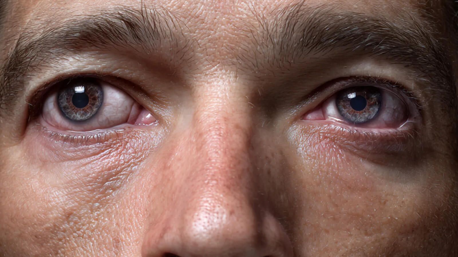 Close-up of the eye area of a person with exotropia