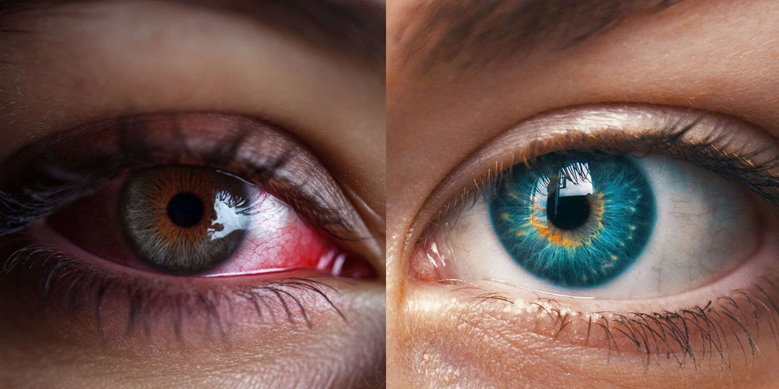 Comparison between an eye with uveitis and a normal eye