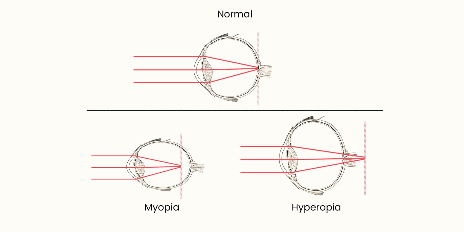 Three different visions with different refractive powers: normal, myopia and hyperopia