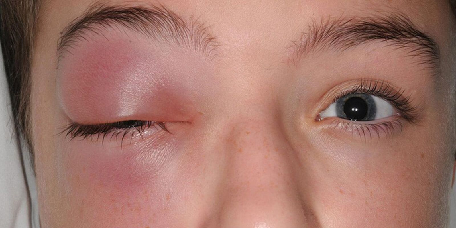 a child got cellulitis
